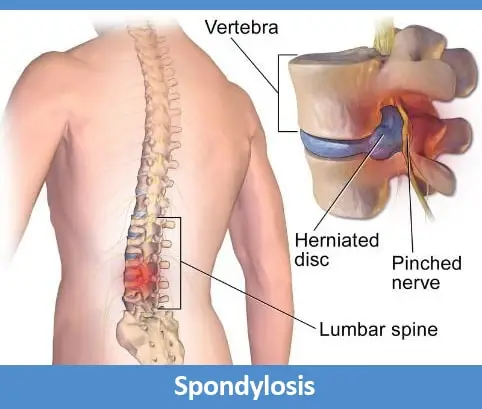 Spndylosis