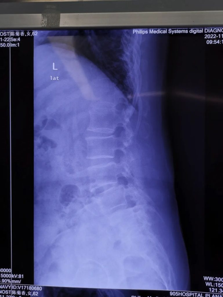 Case Study 1 of patient with spine spondylosis