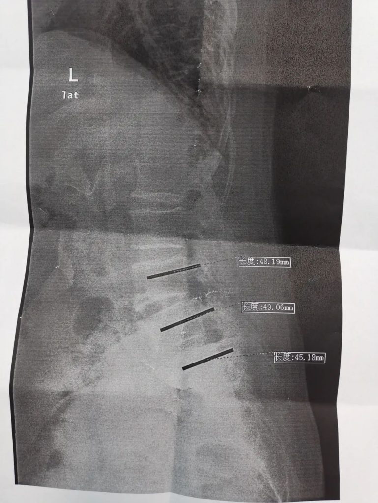 Intraoperative fluoroscopy of Case 1