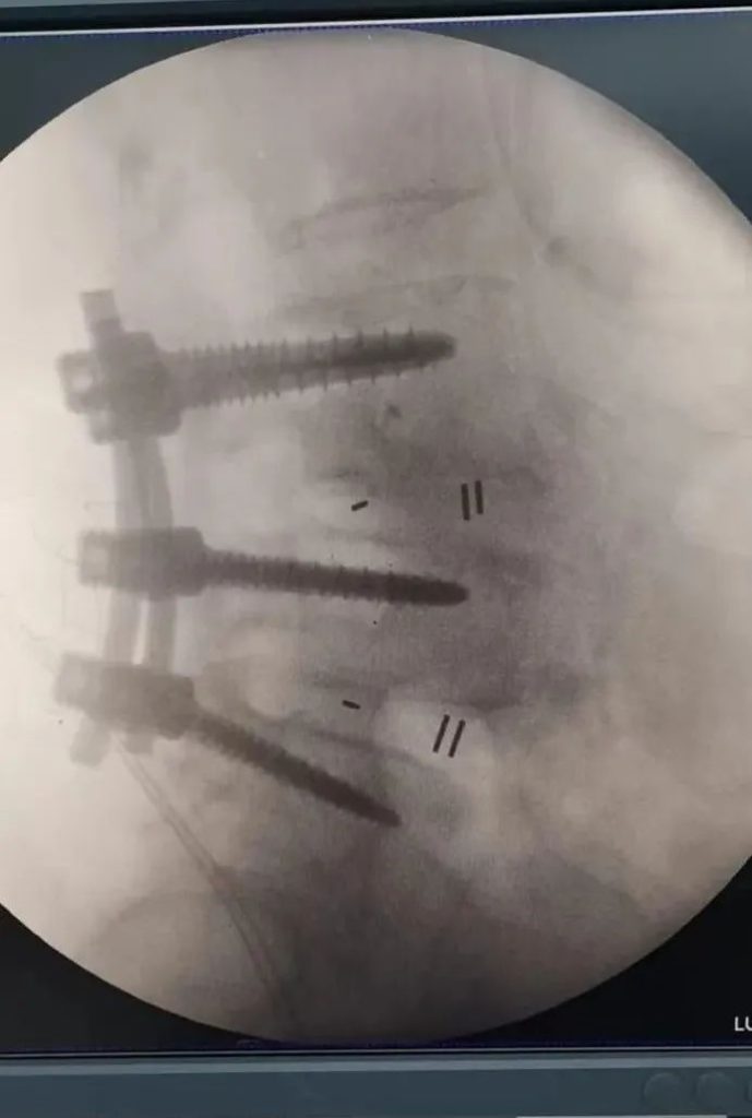 Post-operative Fluoroscope