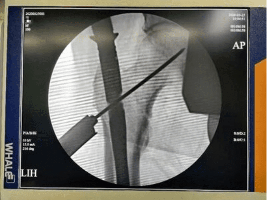 Canwell Tri-Max Nail for Intertrochanteric Fracture Surgery - Case Study