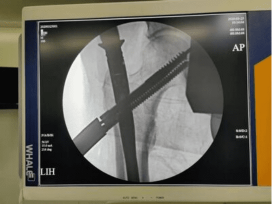 Canwell Tri-Max Intramedullary Nail Cases Sharing