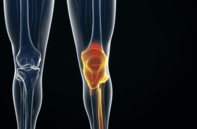 Meniscus Knee Injuries