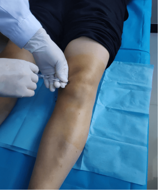Meniscus Knee Injuries