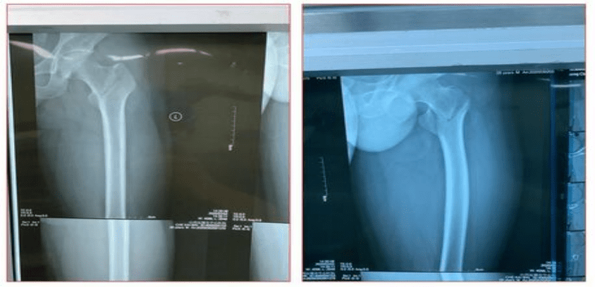 Canwell Tri-Max Intramedullary Nail Cases Sharing