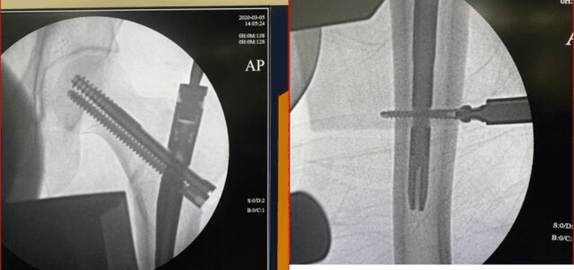 Canwell Tri-Max Intramedullary Nail Cases