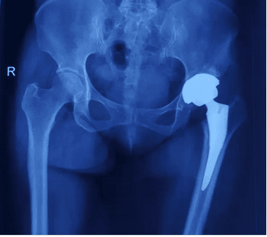 Artificial Joints