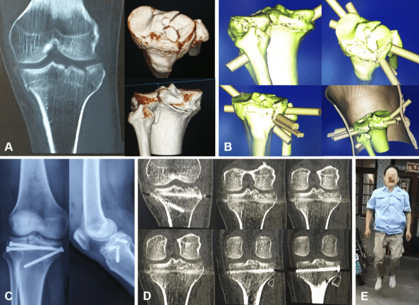 3D Printing in Orthopedics