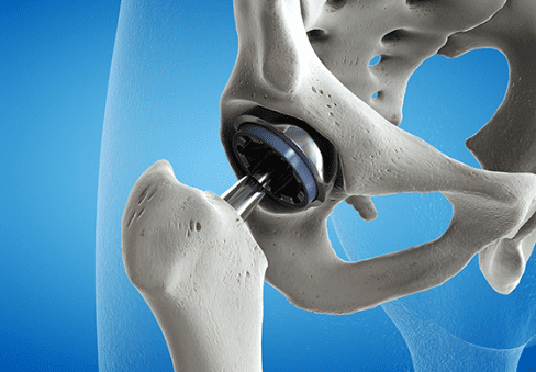artificial joints