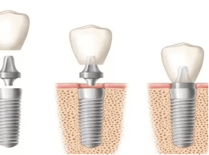 dental implants