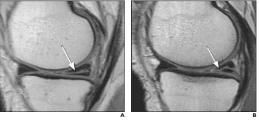 meniscal injury