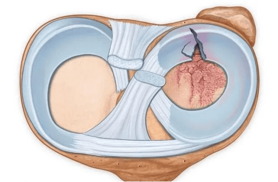 meniscal injury