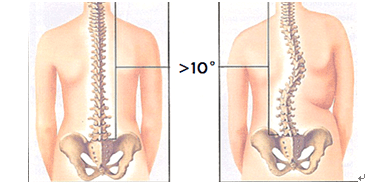 Spinal Scoliosis