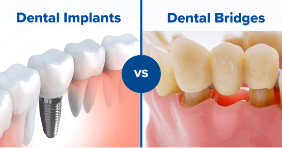 Dental Implants vs. Dental Bridges