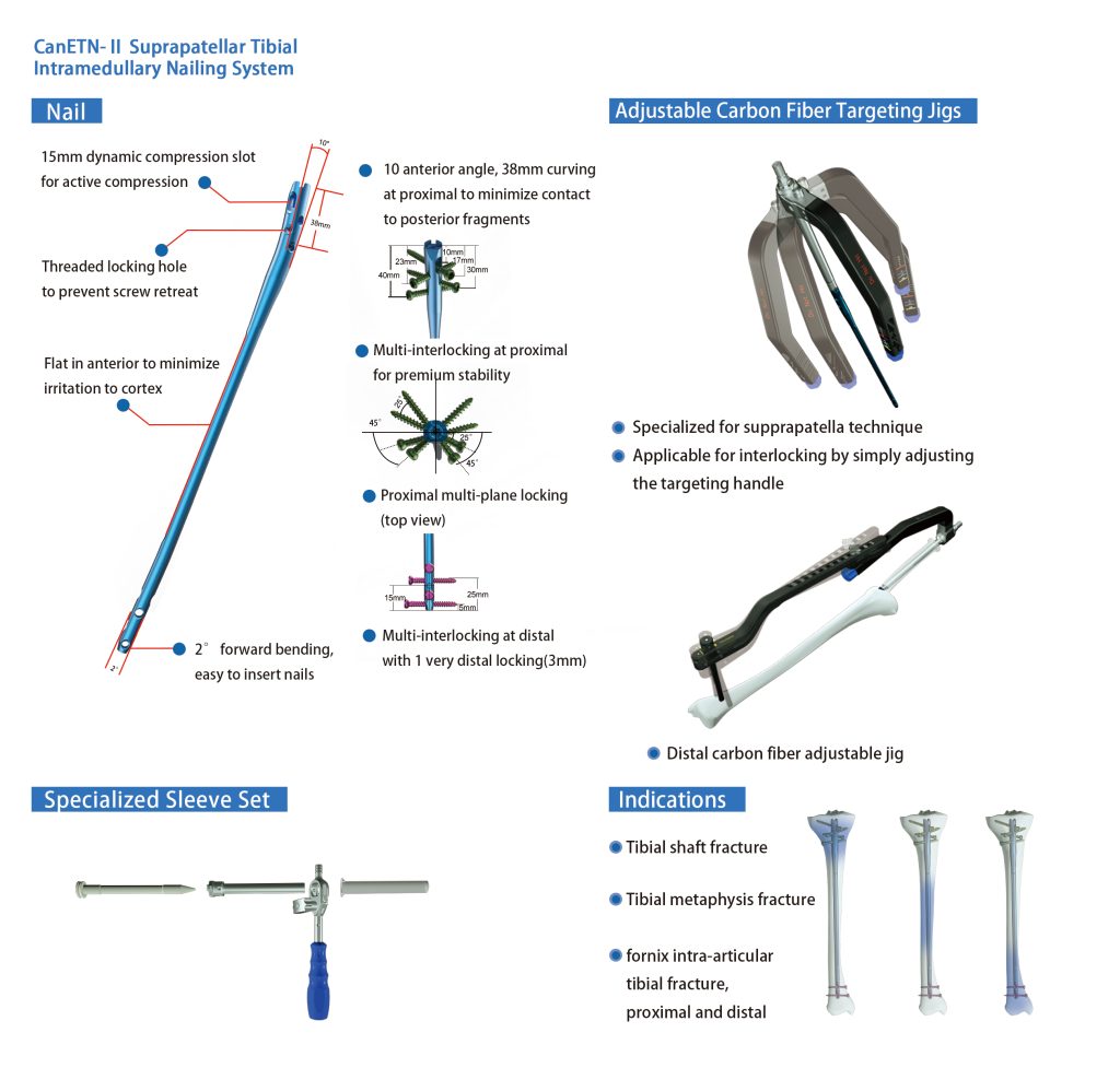 Extended Indications of Intramedullary Nailing in Treatment of Type VI  Schatzker Tibial Plateau Fractures: A Case Report