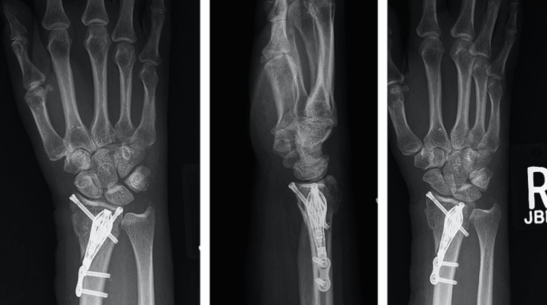 Four new internal fixation techniques for distal radius fractures