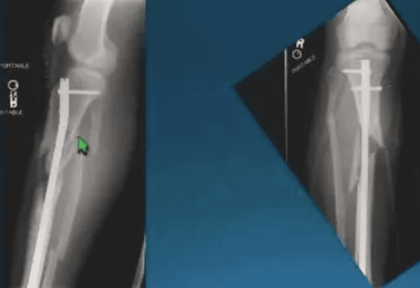 Biomechanical comparison of distal locking screws for distal tibia fracture intramedullary  nailing