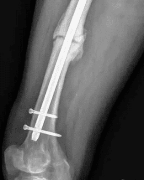 Retrograde nailing in a tibial fracture | Revista Española de Cirugía  Ortopédica y Traumatología (English Edition)