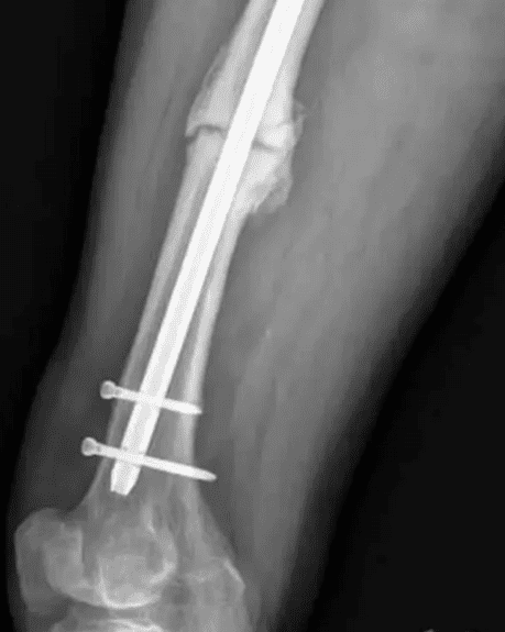 Management of tibial non-unions: Prospective evaluation of a comprehensive  treatment algorithm